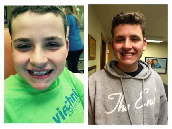 One mom reflects on the day her son's braces came off.